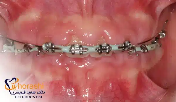 التهاب شدید لثه در دوره ارتودنسی