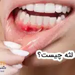 عفونت لثه چیست