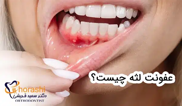 عفونت لثه چیست