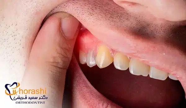 عکس عفونت لثه
