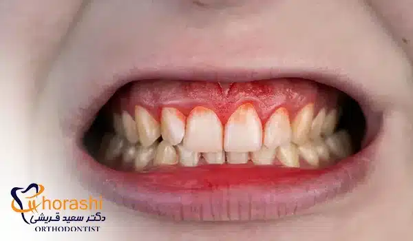 علائم عفونت لثه