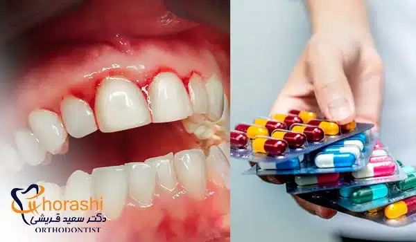 آنتی بیوتیک برای عفونت لثه