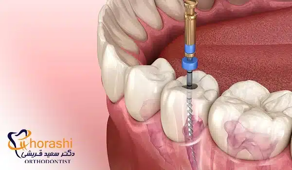 درمان ریشه دندان