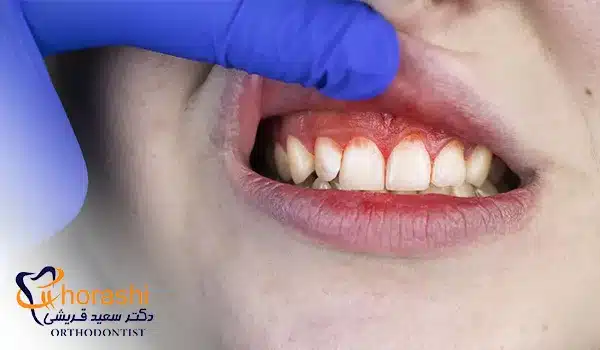 لثه عفونتی