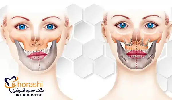 خطرات بعد از انجام جراحی اصلاح فک
