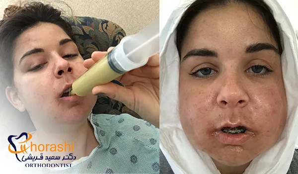 تورم صورت و باز شدن محدود دهان؛ یکی از عوارض جراحی فک