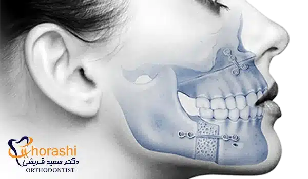 شل شدن پیچ و اتصالات پس از جراحی فک