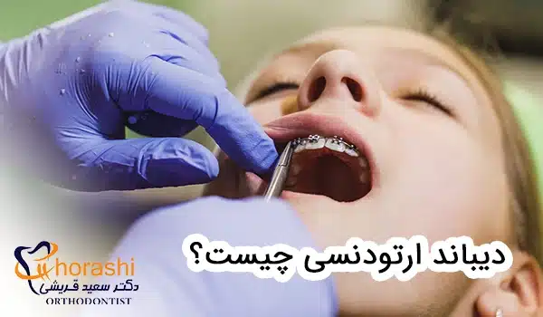 دیباند ارتودنسی چیست؟