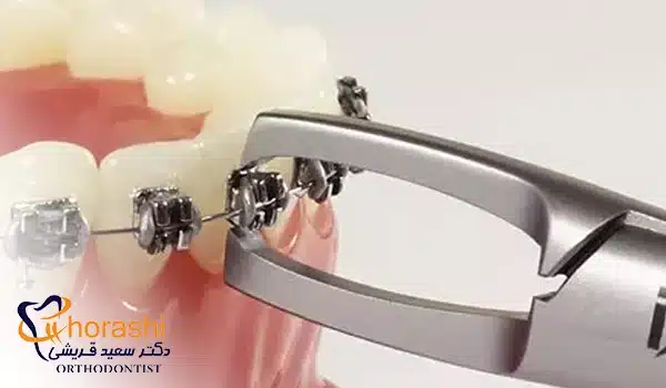 دیباندینگ ارتودنسی ثابت
