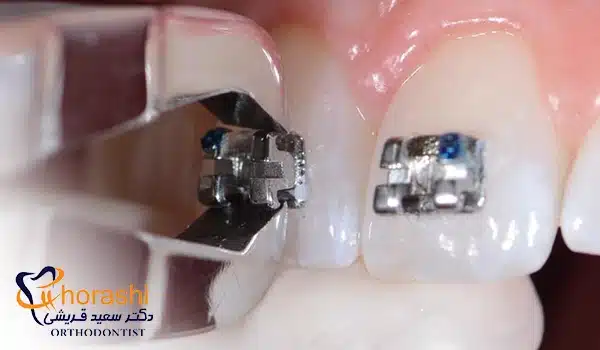 دیباند ارتودنسی فلزی