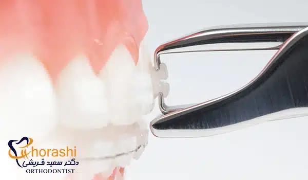دیباندینگ ارتودنسی سرامیکی