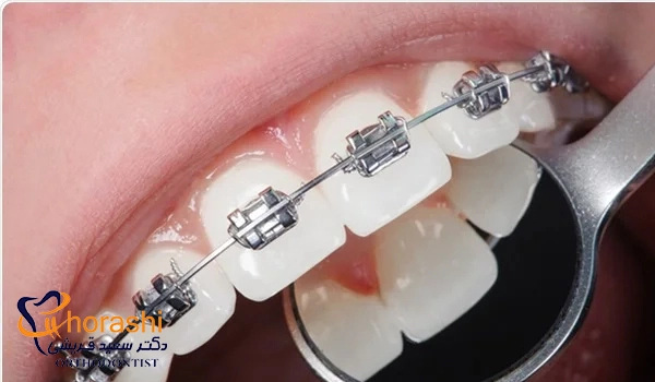 عدم پوسیدگی دندان در ارتودنسی با رعایت مناسب بهداشت