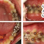 پوسیدگی دندان در ارتودنسی