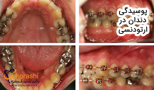 پوسیدگی دندان در ارتودنسی