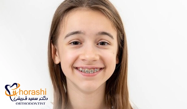 ارتودنسی ثابت برای دندان شیری