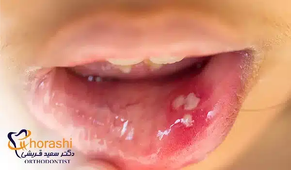 عکس آفت دهان کودک