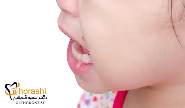 آفت لب کودک