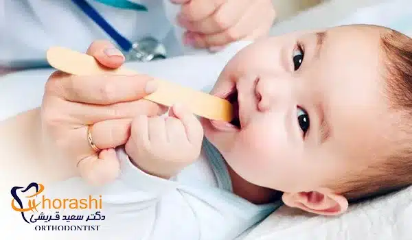 درمان افت دهان نوزاد توسط پزشک