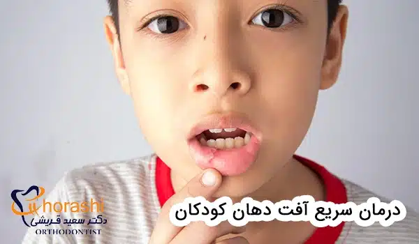 درمان سریع آفت دهان کودکان
