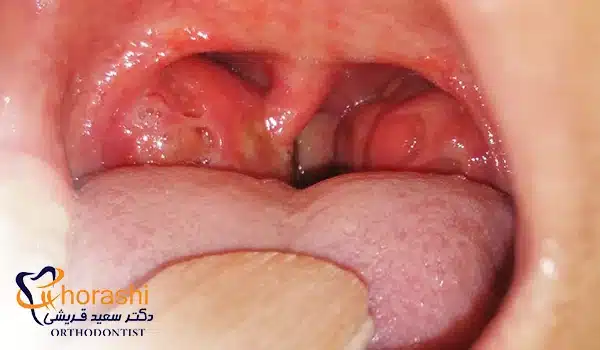 عکس التهاب لوزه، یکی از بیماری های لوزه