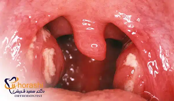 تصویر عفونت لوزه، یکی از بیماری های شایع لوزه در افراد