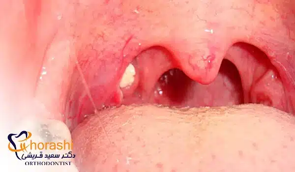 سنگ لوزه؛ یکی از انواع بیماری لوزه