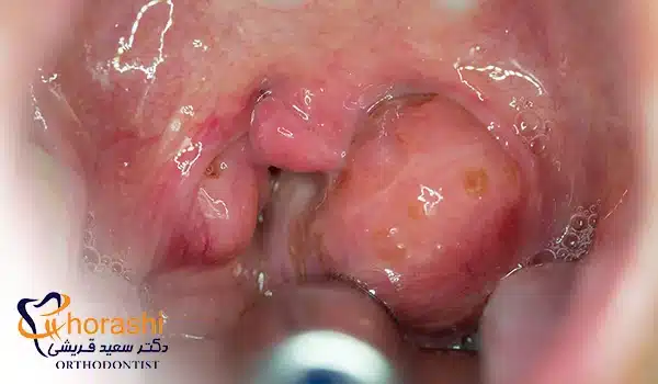علائم سرطان لوزه