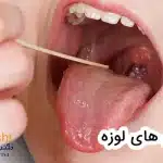 بیماری های لوزه