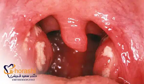 عکس لوزه عفونت کرده
