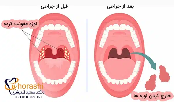 عمل جراحی برای خارج کردن لوزه عفونت کرده