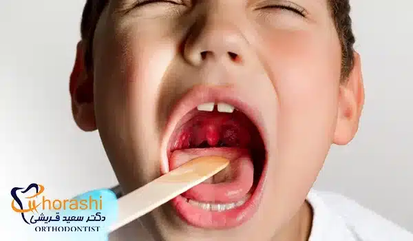 عفونت کردن لوزه کودکان