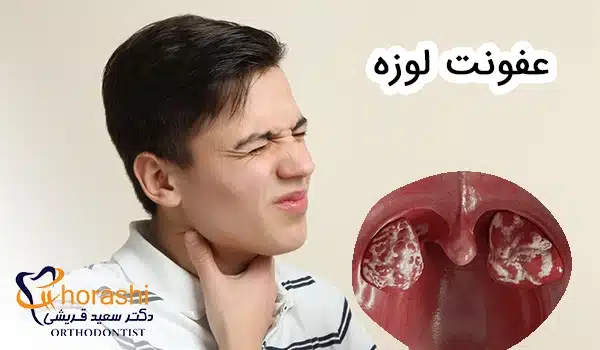 عفونت لوزه