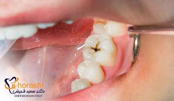 پوسیدگی دندان، عامل اصلی عفونت در بارداری