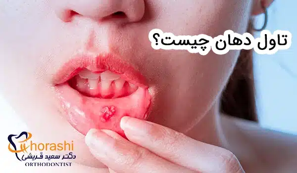 تاول دهان چیست؟