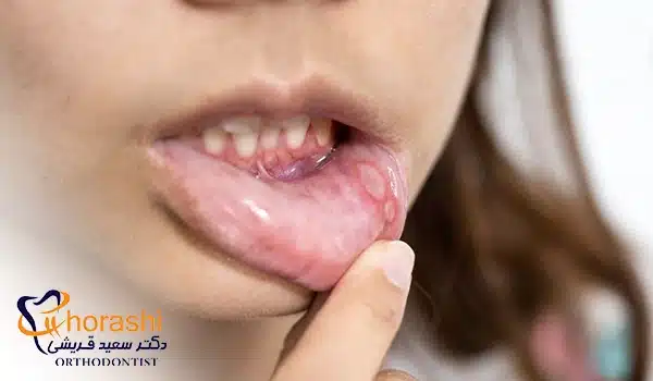 عکس تاول دهان