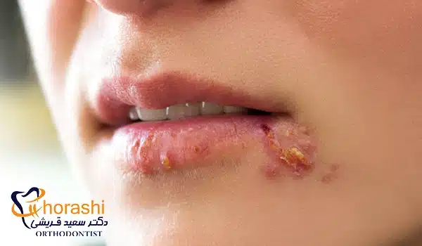 تاول لب براثر تبخال