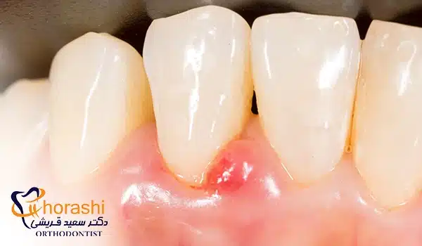 تاول زدن در دهان له دلیل ژنژیووماتیت