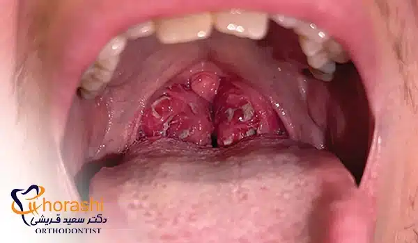 بروز تاول های انتهای گلو به خاطر مونونوکلئوز عفونی