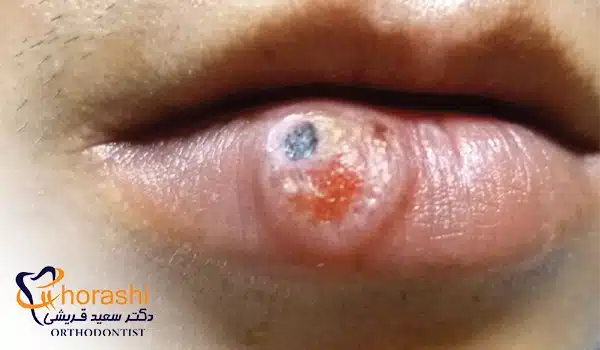 تاول روی لب به دلیل زخم شانکر