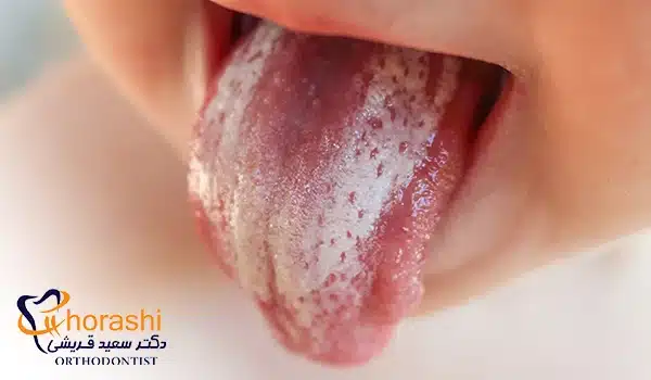 بروز تاول روی زبان به خاطر برفک دهان