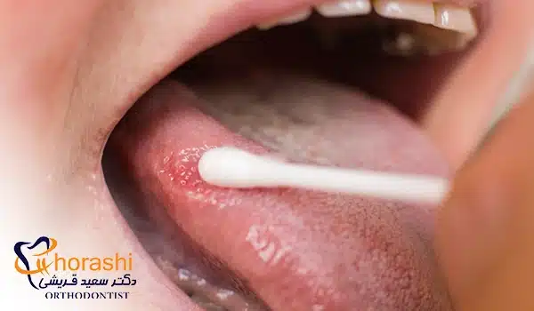 لکوپلاکیا و بروز تاول های کنار زبان