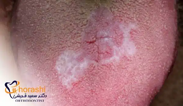 لیکن پلان و عارضه تاول های زبانی