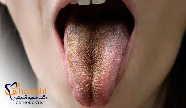 زبان مودار سیاه