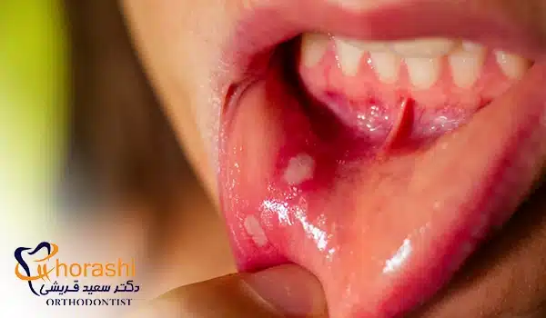 آفت و تاول داخل لب