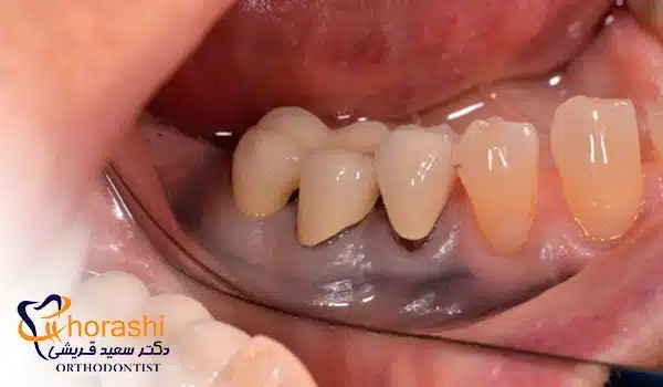 خالکوبی آمالگام