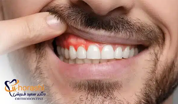 بروز تاول در مراحل پیشرفته ژنژیویت