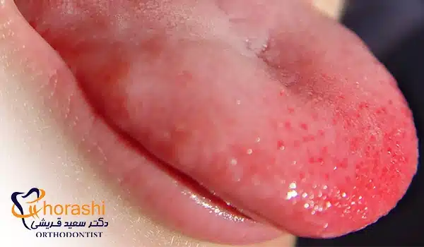 سوختن زبان و ایجاد تاول