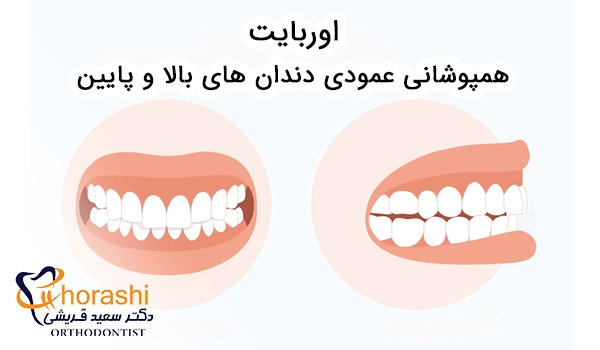 اوربایت از نمای روبرو و نیم رخ