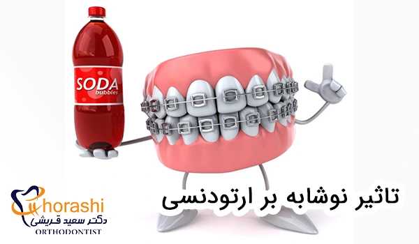 تاثیر نوشابه بر ارتودنسی