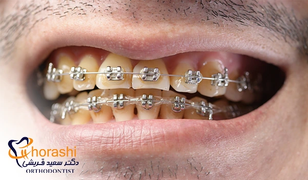 پوسیدگی دندان در اتودنسی ثابت به دلیل مصرف نوشابه با ارتودنسی